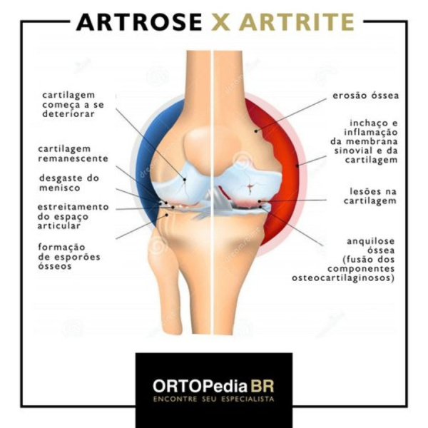 artrose-artrite