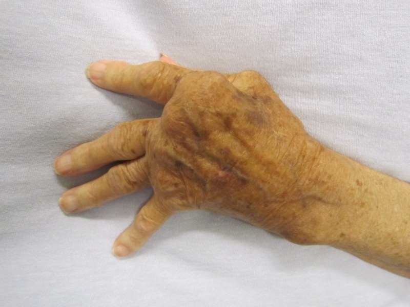 maos-com-artrite-reumatoide